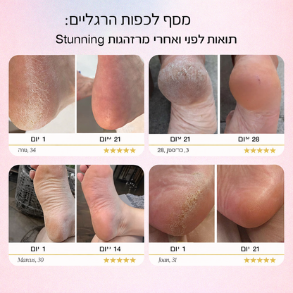 מכשיר חשמלי להסרת יבלות בכפות הרגליים Dermalux™